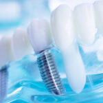 методи-на-имплантиране-зъбни-импланти-дента-консулт