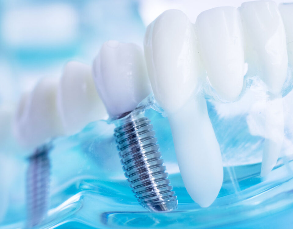 методи-на-имплантиране-зъбни-импланти-дента-консулт