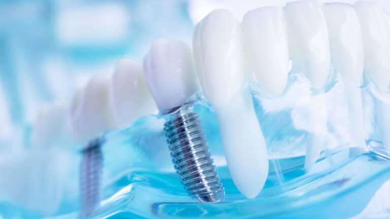 методи-на-имплантиране-зъбни-импланти-дента-консулт