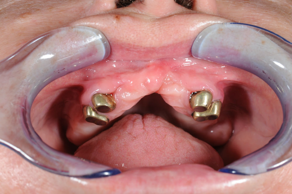 лечение-без-зъбни-импланти-магнити