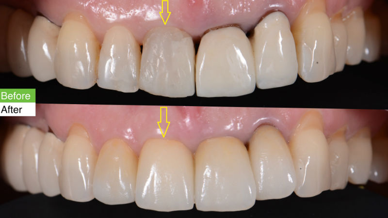 Зъби-върху-зъбни-импланти-преди-след