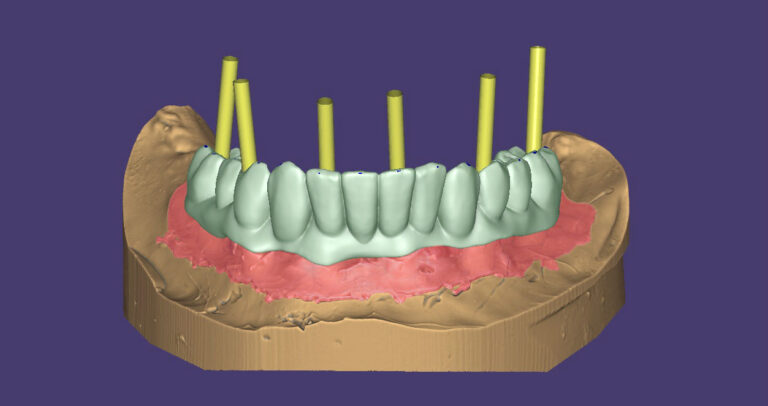 Зъби-върху-зъбни-импланти-протезиране