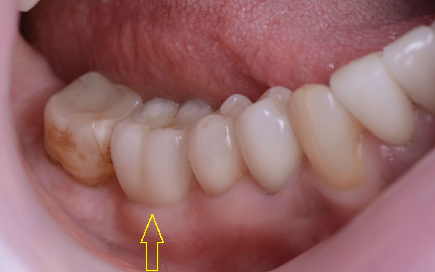 Зъби-върху-зъбни-импланти-след