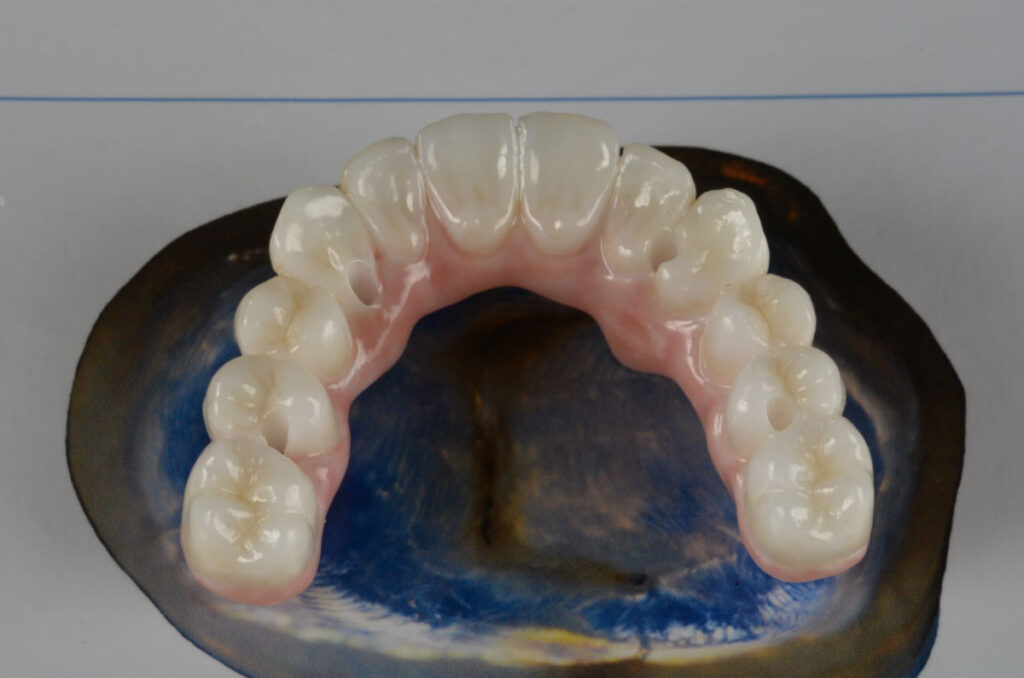 Протезиране-зъбни-импланти-протеза-2