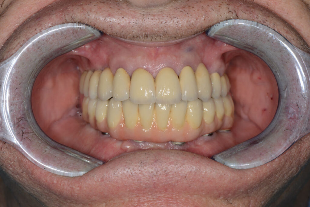 Протезиране-зъбни-импланти-протеза-4