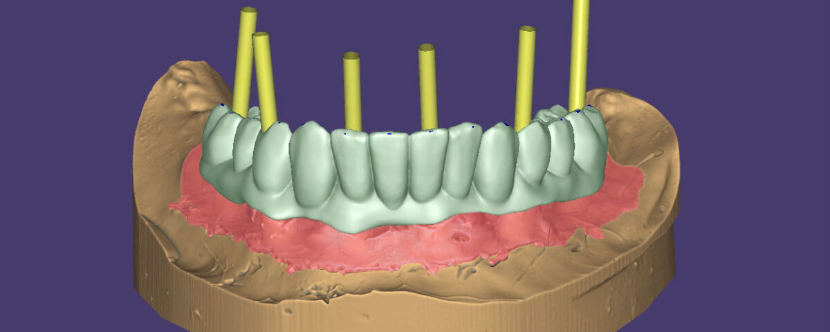 Зъби-върху-зъбни-импланти-протезиране