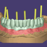 Зъби-върху-зъбни-импланти-протезиране