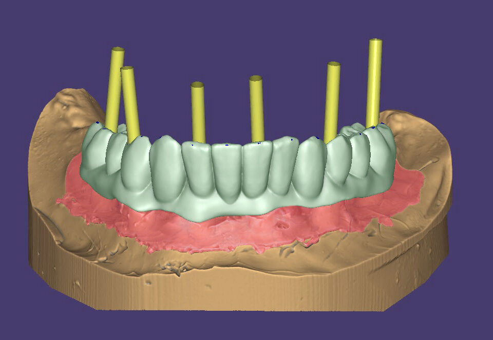 Зъби-върху-зъбни-импланти-протезиране