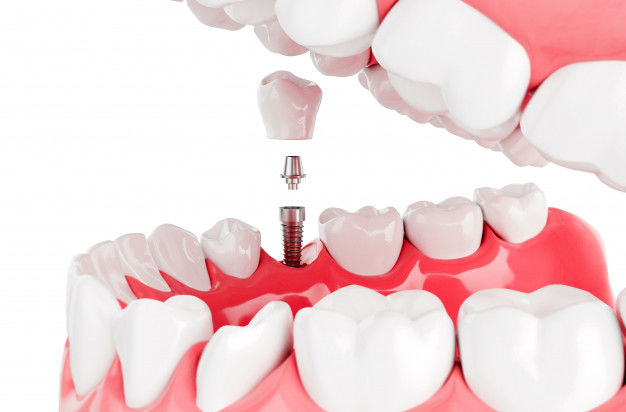 зъби-върху-зъбни-импланти-проект-преди-поставяне