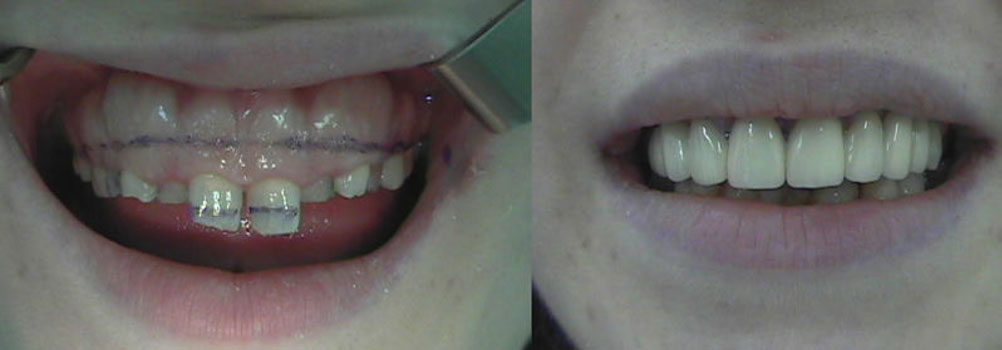Зъбни-импланти-планиране-пълна-промяна-преди-след