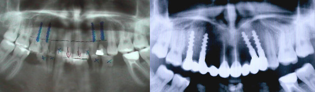 Зъбни-импланти-пълна-промяна-планиране