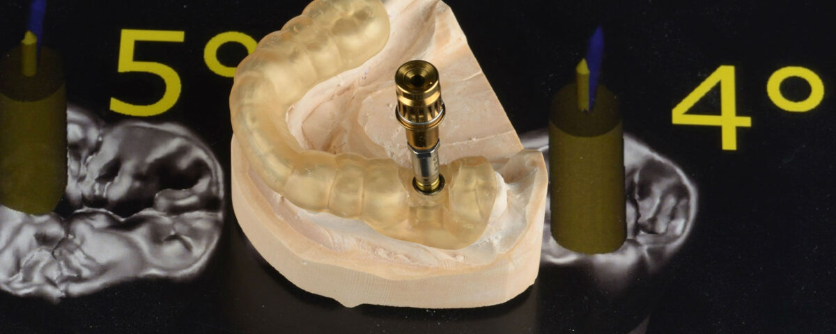 зъбни-импланти-3d-модел-exocad-style-denta-consult