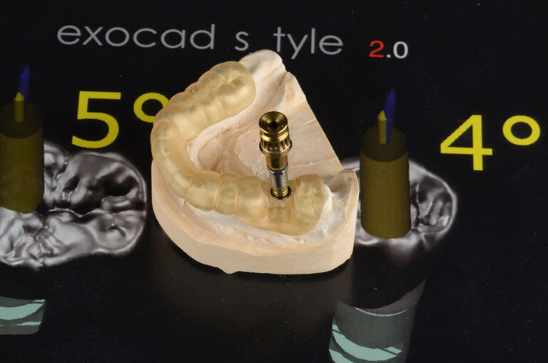 зъбни-импланти-3d-модел-exocad-style-denta-consult