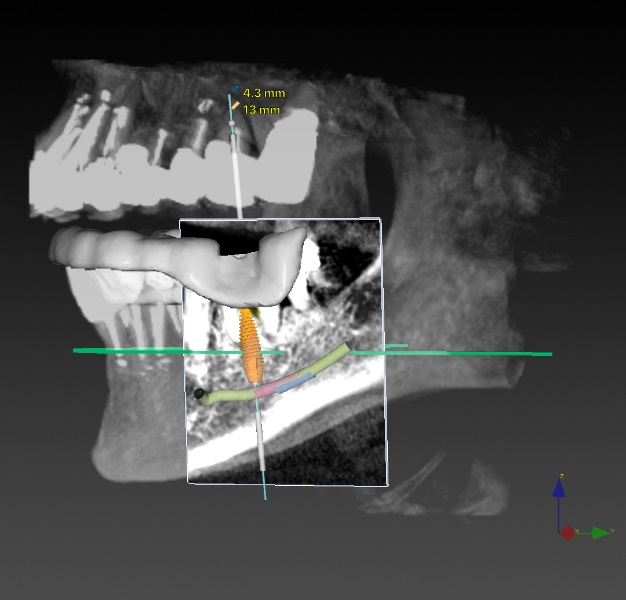 зъбни импланти-снимка-рентген