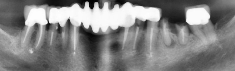 снимка-на-зъбна-редица-без-поставен-имплант