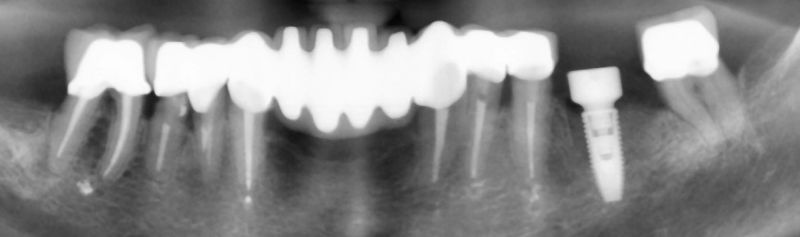 снимка-на-зъбна-редица-с-поставен-имплант