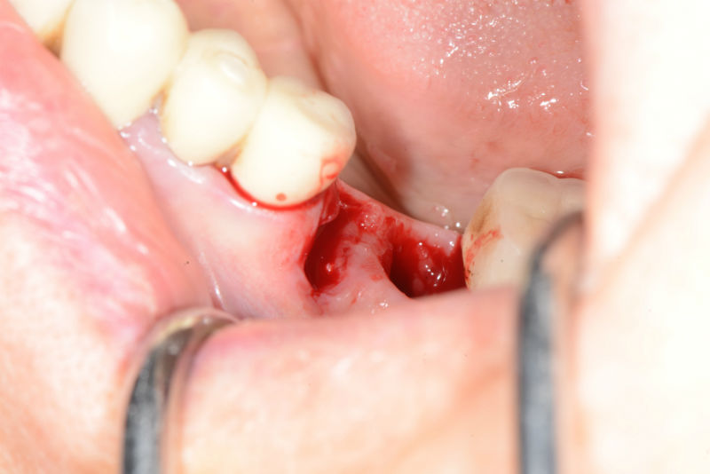 изработка-на-хирургичен-водач-зъбен-имплант-2