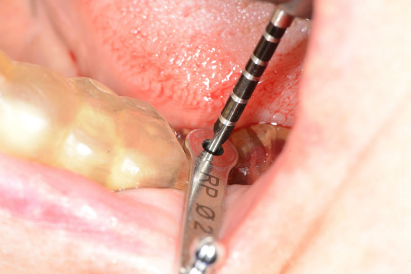 изработка-на-хирургичен-водач-зъбен-имплант-3