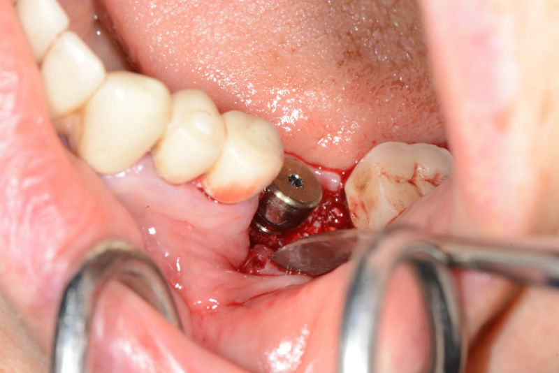 изработка-на-хирургичен-водач-зъбен-имплант-4