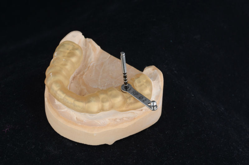 протеична-позиция-продължение-на-зъбен-имплант-2
