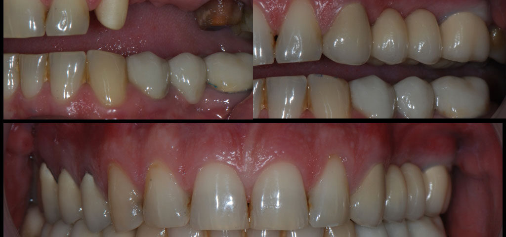 лечение-със-зъбни-мостове