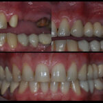 лечение-със-зъбни-мостове