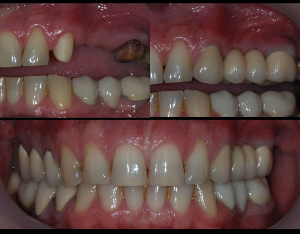 лечение-със-зъбни-мостове