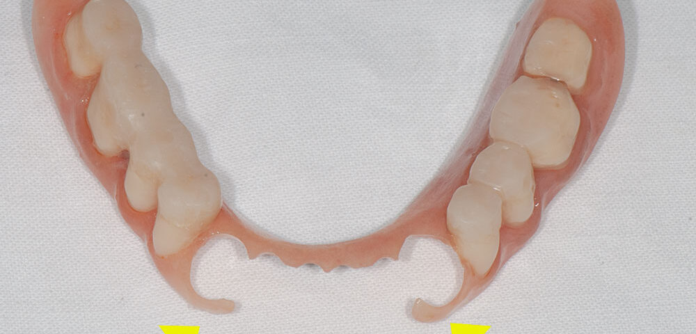 силиконови-зъбни-протези-2