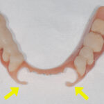 силиконови-зъбни-протези-2