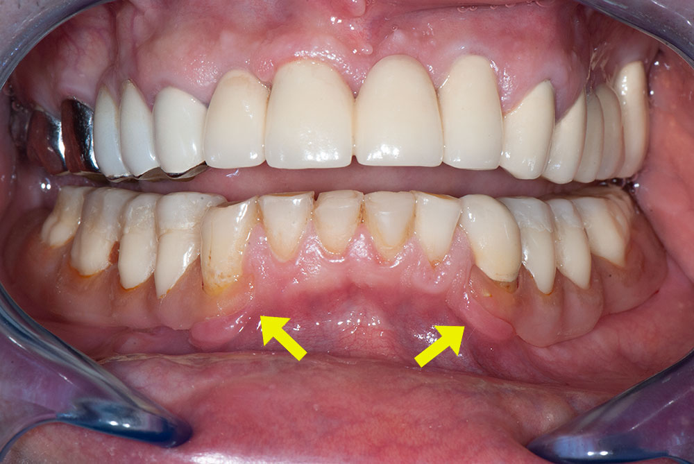 силиконови-зъбни-протези-1