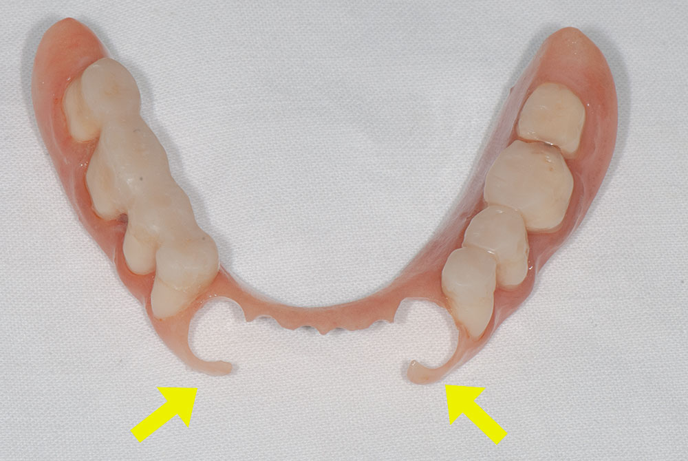 силиконови-зъбни-протези-2