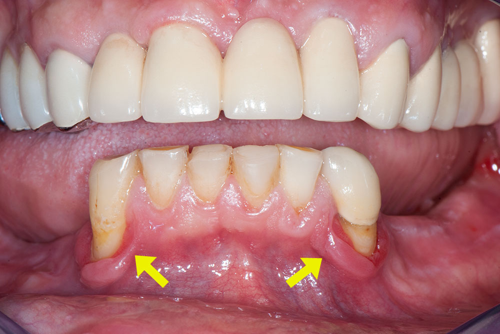 силиконови-зъбни-протези-3