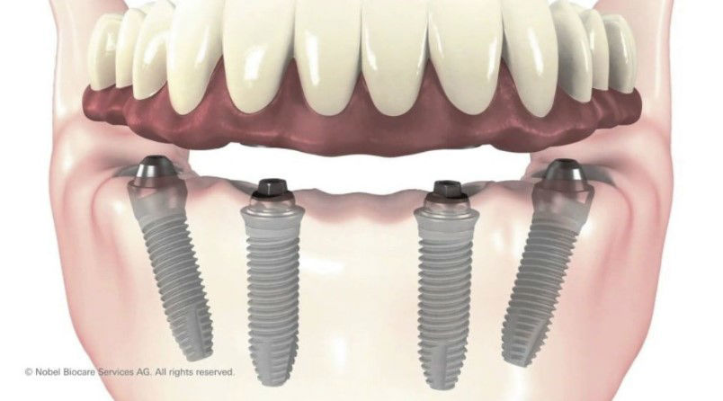 концепцията зъбни импланти All on 4 от Palo Malo и Nobel Biocare