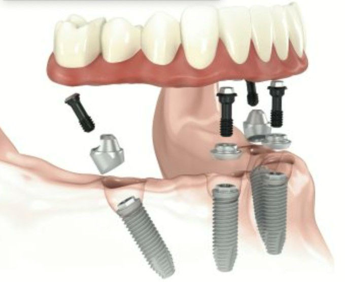Зъбни-импланти-Nobel-Speedy-DentaConsult