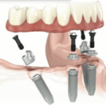 Nobel Speedy зъбни импланти в София