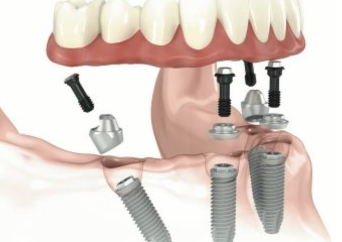 Nobel Speedy зъбни импланти в София