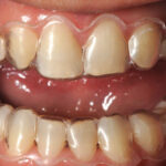 лечение-с-алайнери-дента-консулт