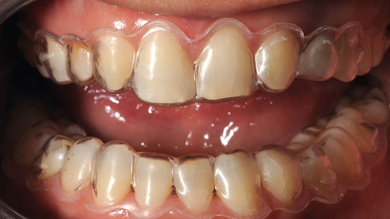 лечение-с-алайнери-дента-консулт