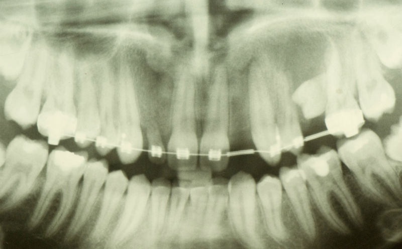 Снимка на зъбите с брекети