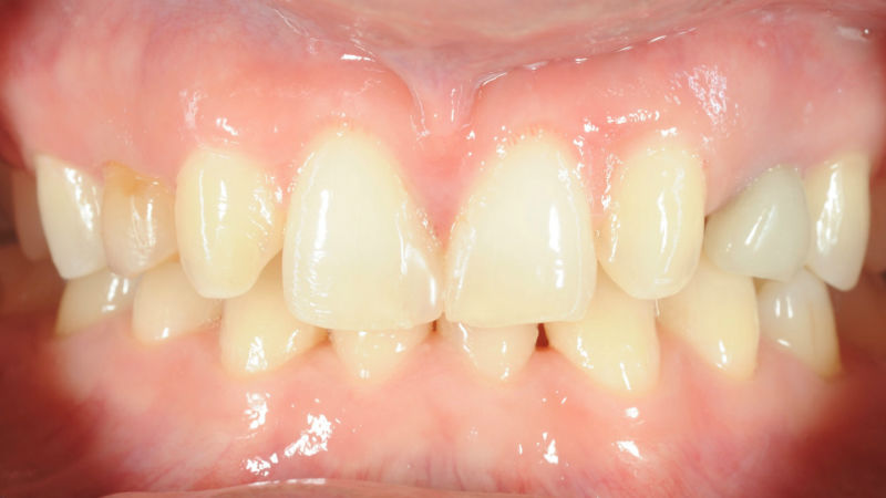 Състояние на зъбите преди лечение с алайнери
