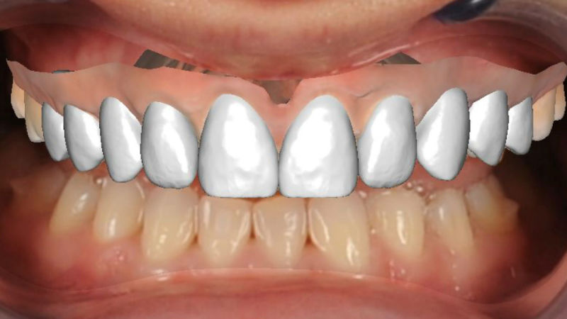 Виртуално-планирано-лечение-с-алайнери-собствени-зъби-6