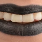 дентална-клиника-поставяне-на-зъбни-импланти-дента-консулт