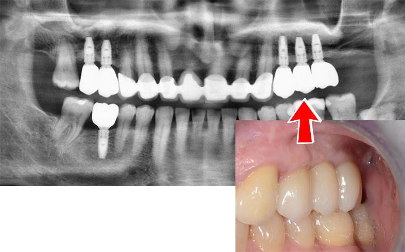 Лечение-със-съвременни-зъбни-импланти